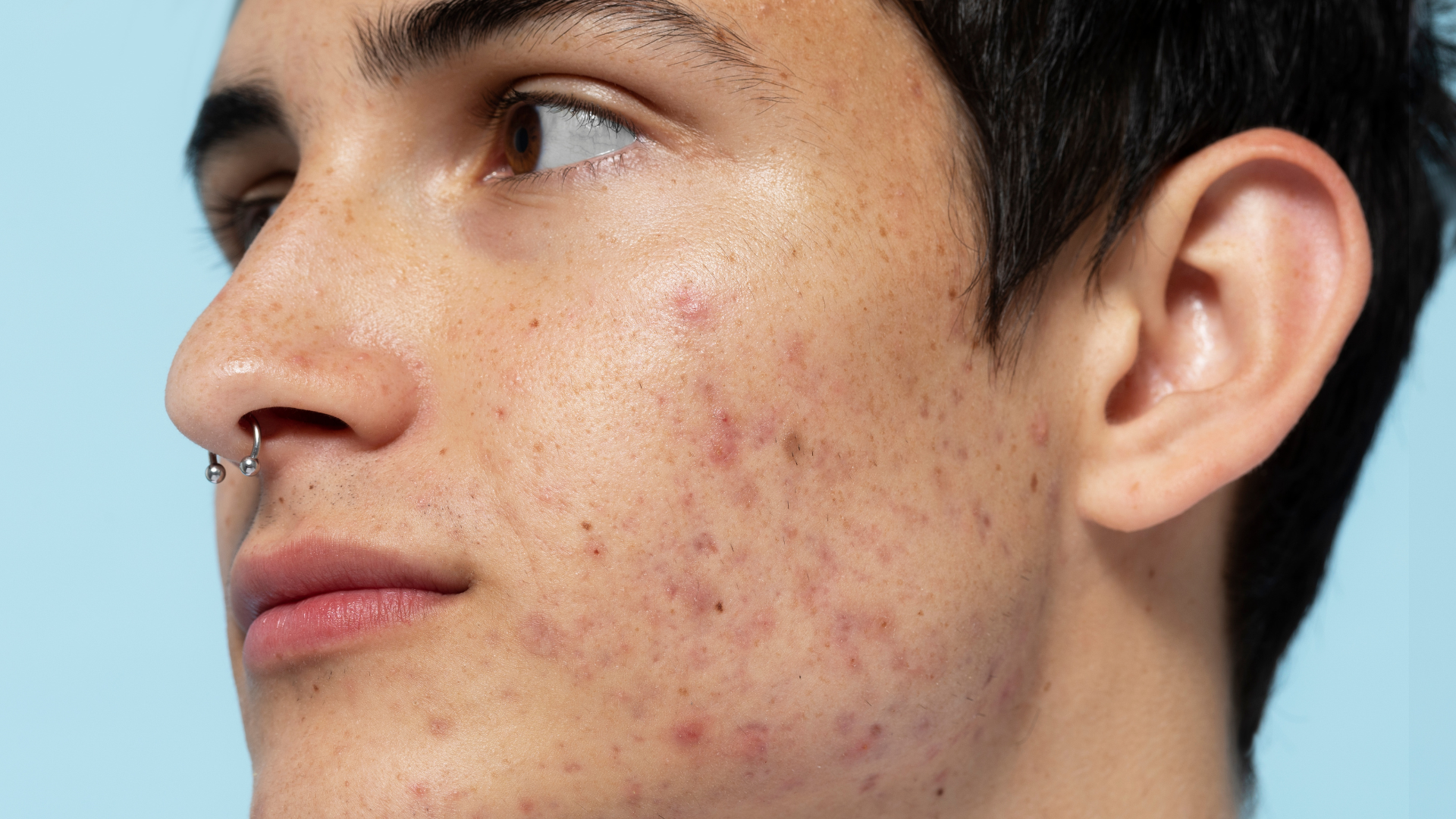 Types of Acne Scars
