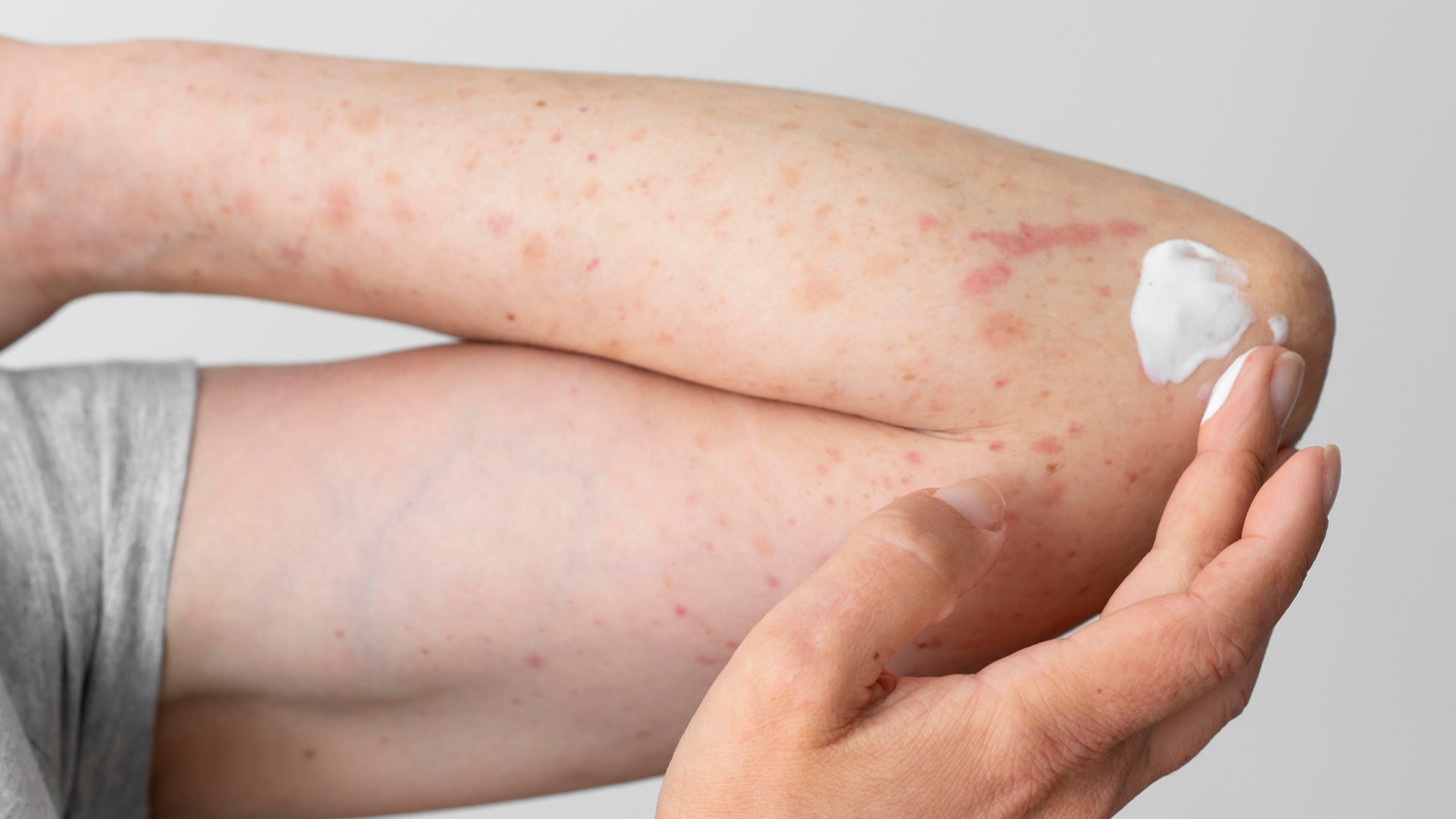 how to cure fungal infection on skin naturally at home