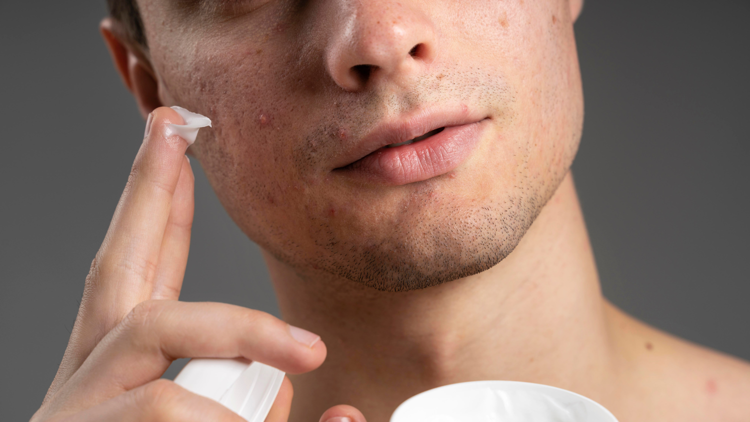 Best Cream for Acne Scars and Dark Spots