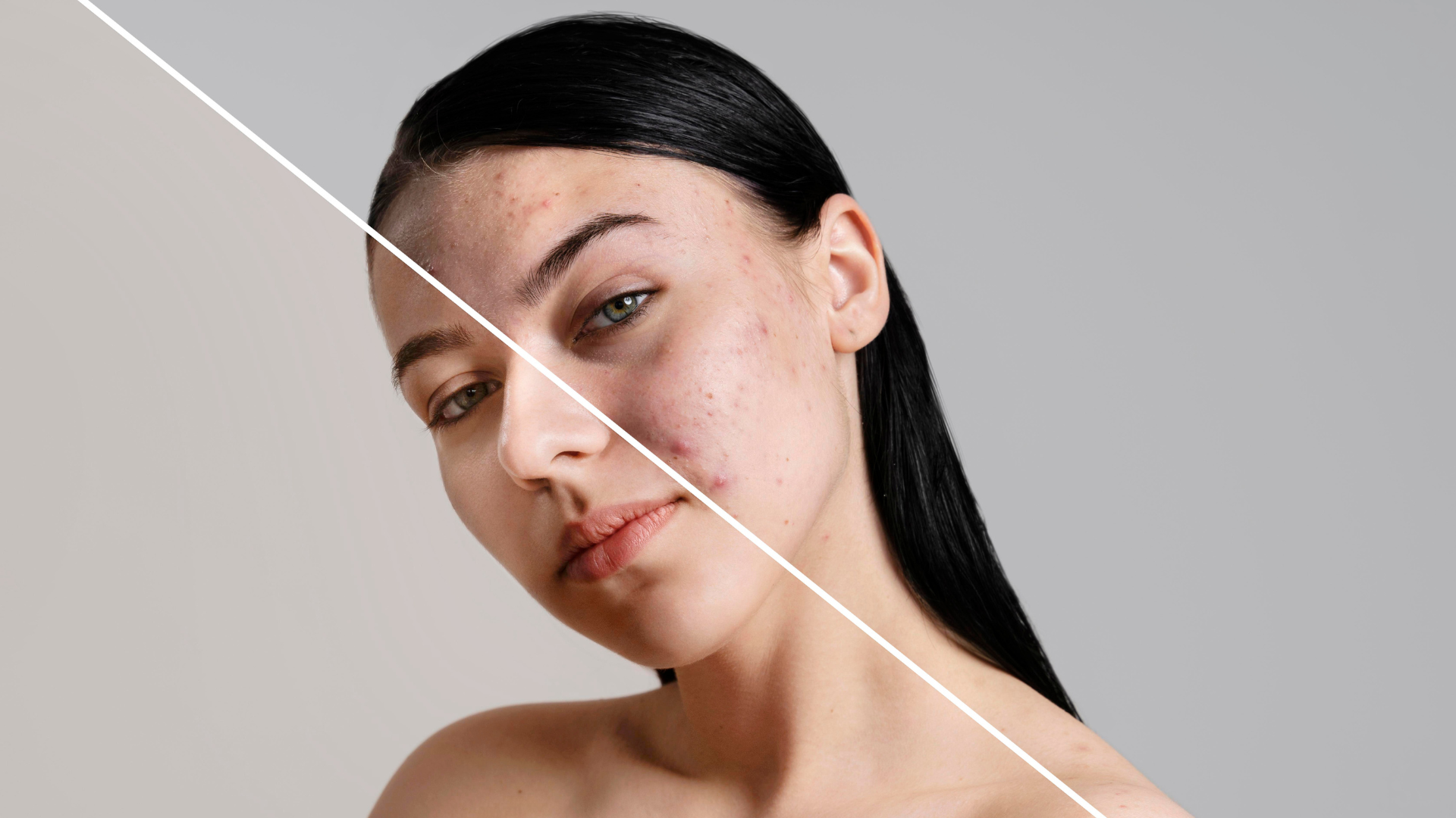 Acne Marks vs Acne Scars