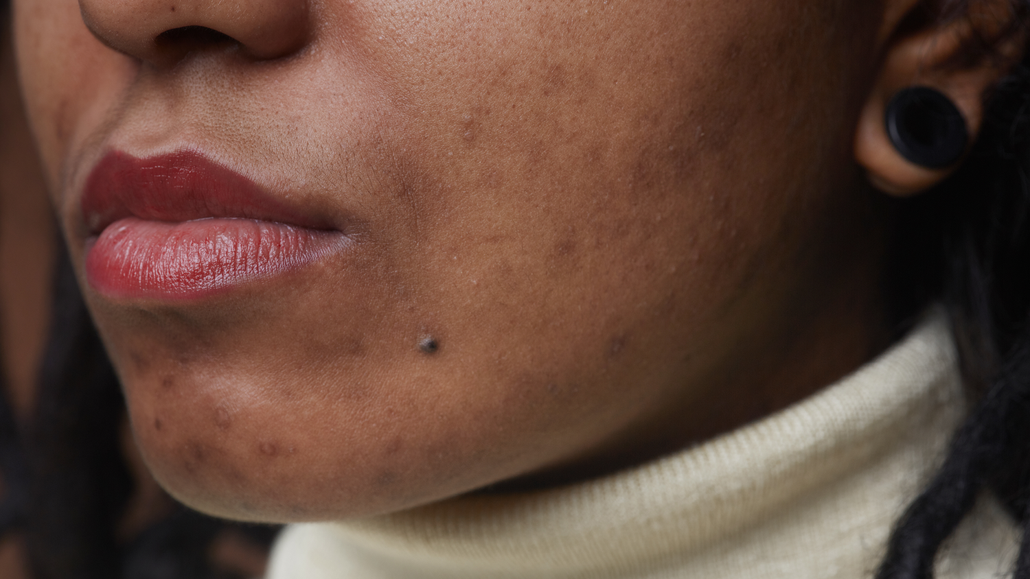 how to remove pigmentation from face permanently