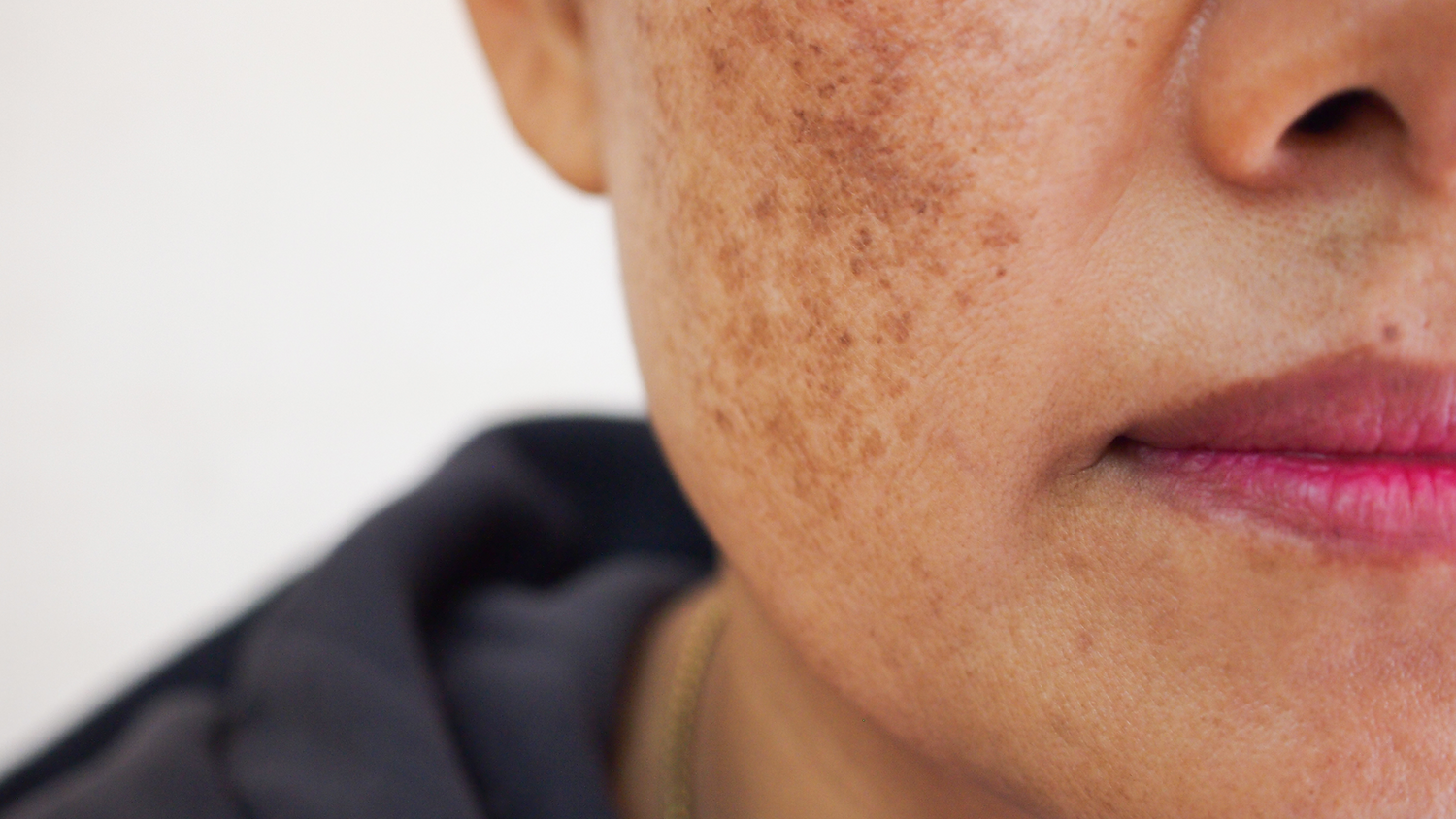 what is pigmentation