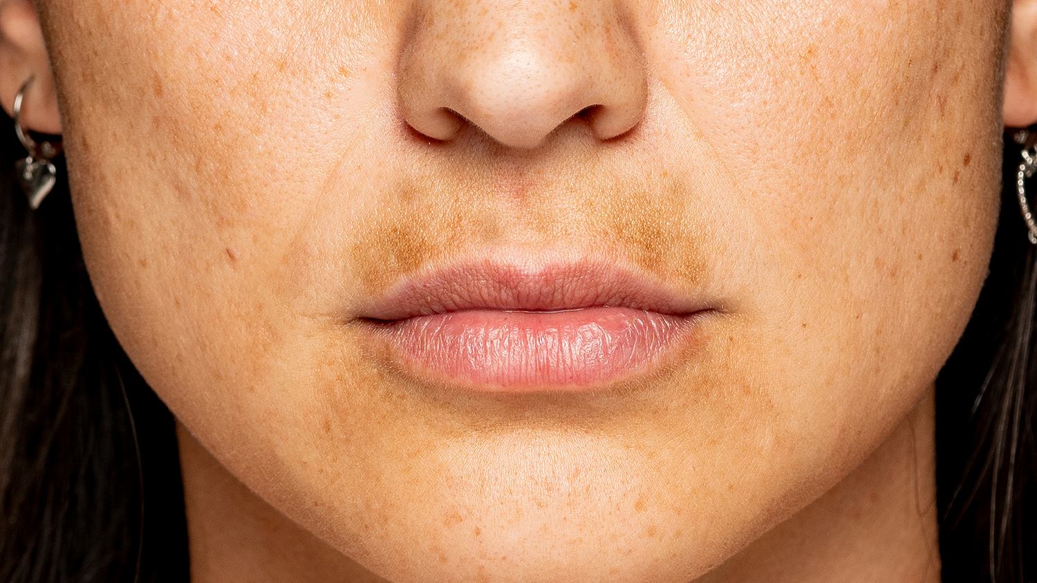 pigmentation around mouth