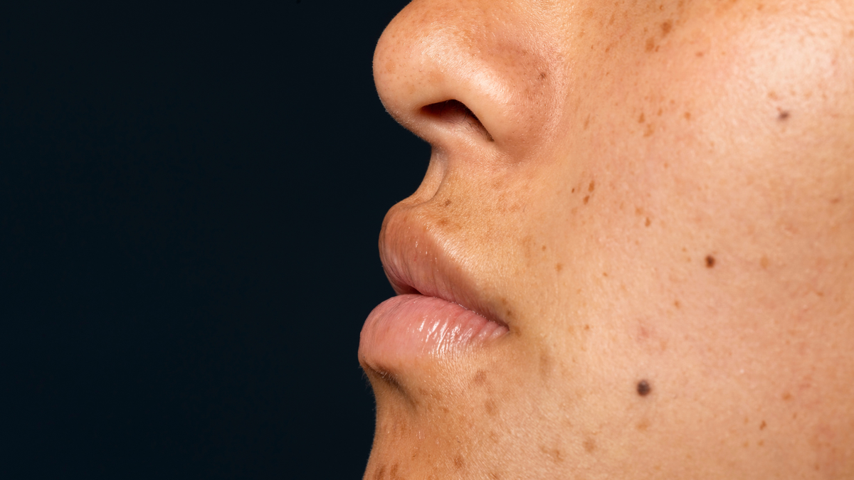 How to Remove Blackheads From Nose at Home
