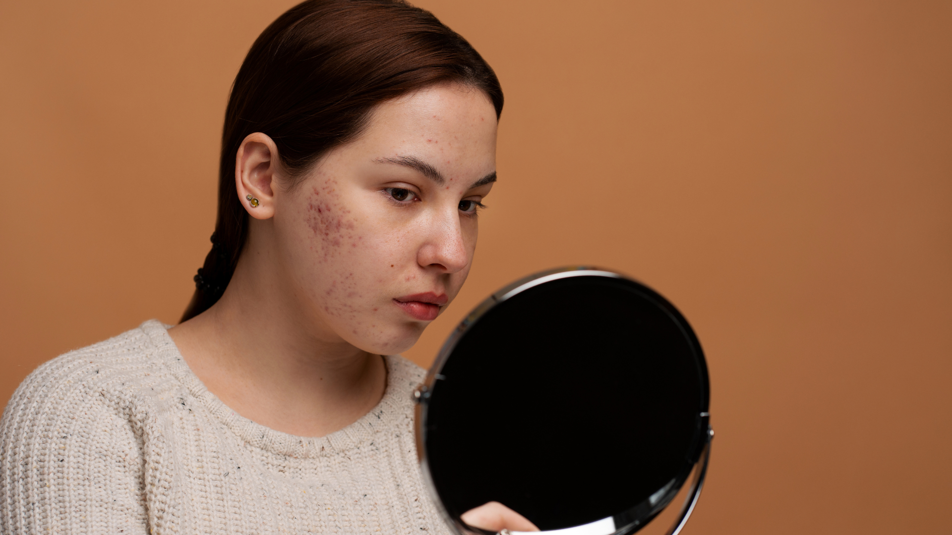 how long does it take for acne scars to fade