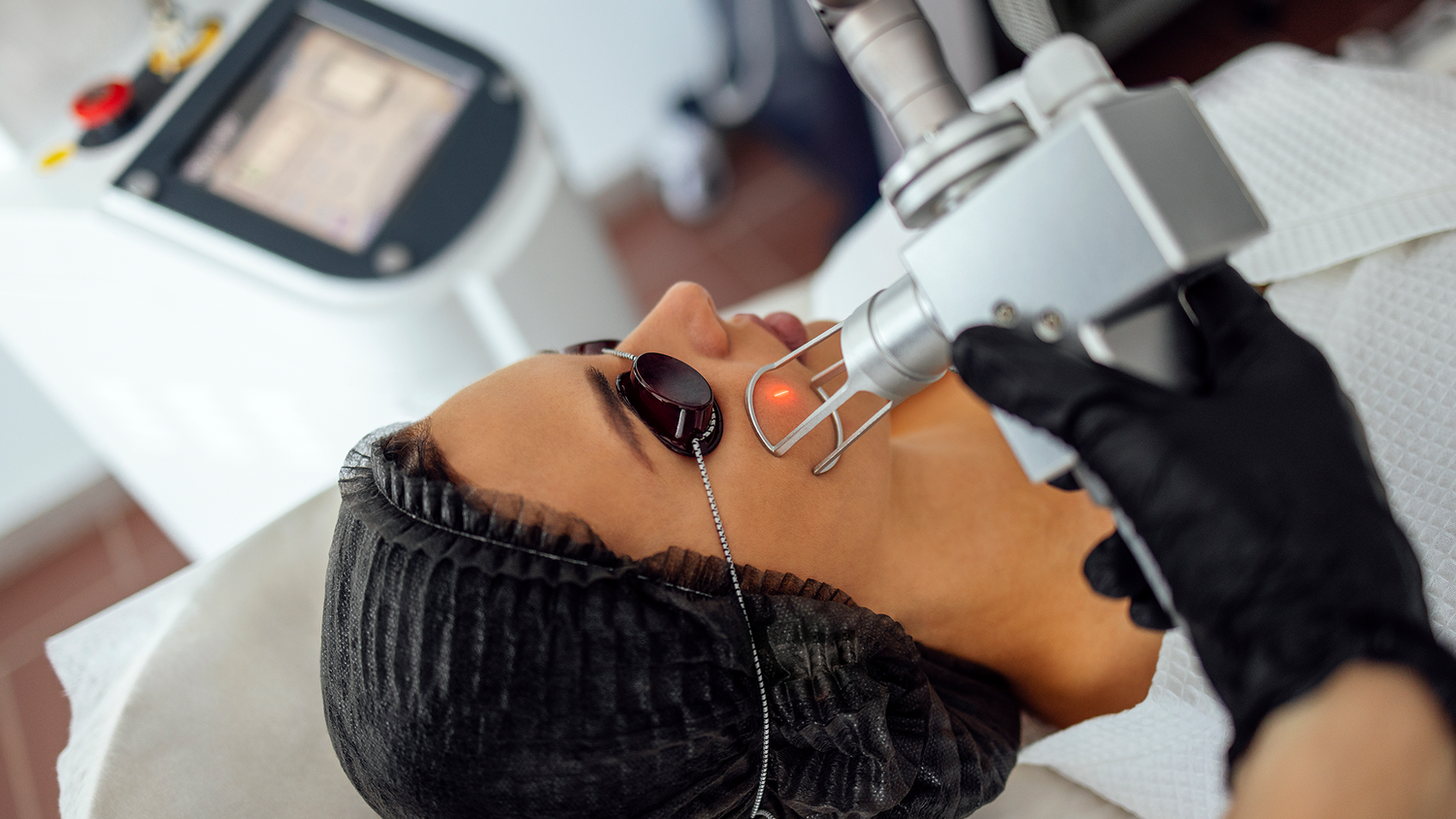 laser treatment for pigmentation