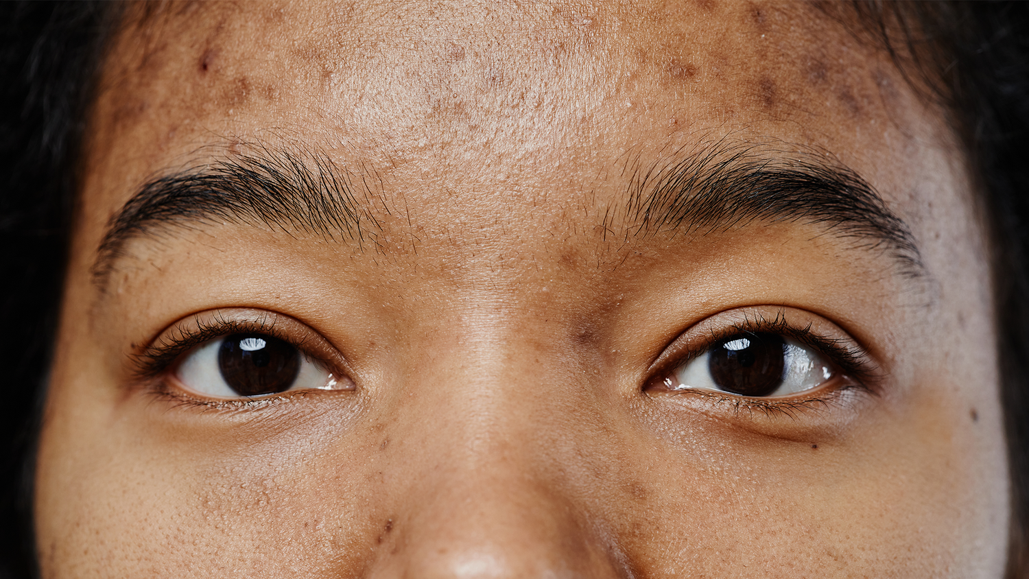 pigmentation on forehead