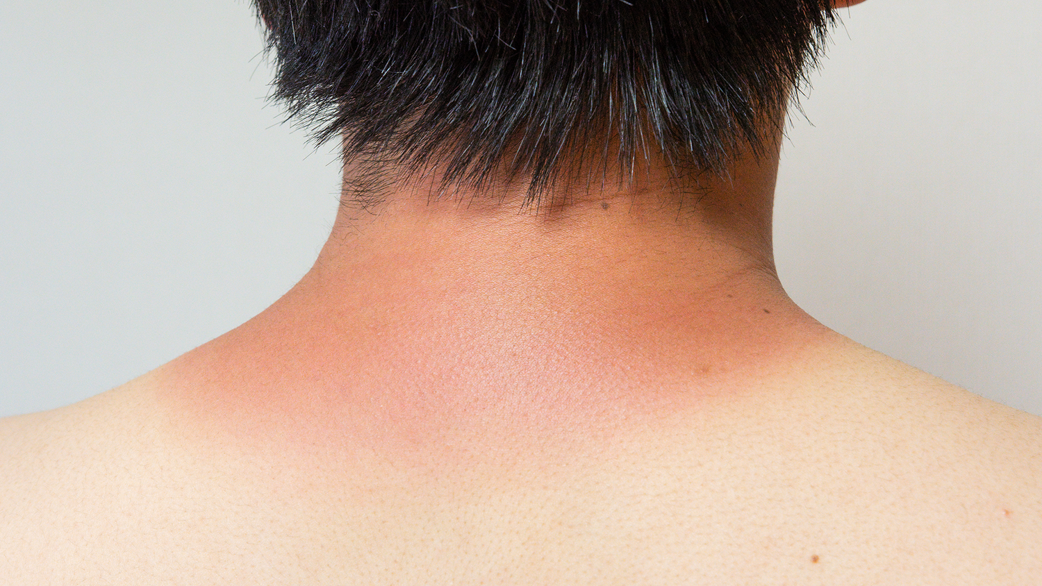 pigmentation on neck