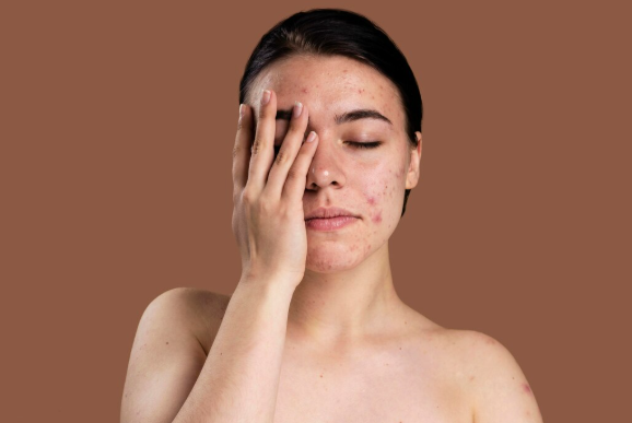 How to Remove Pigmentation from Face