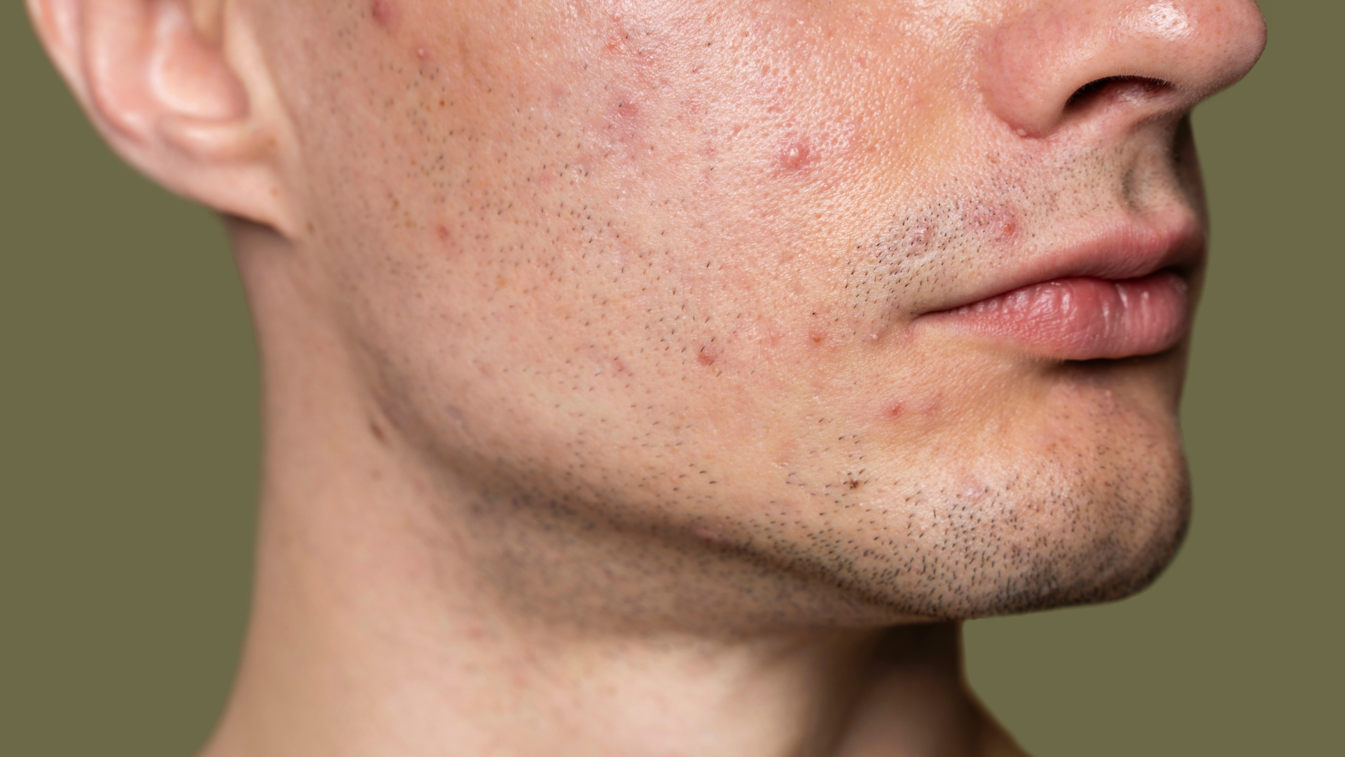 What Is Acne-Prone Skin