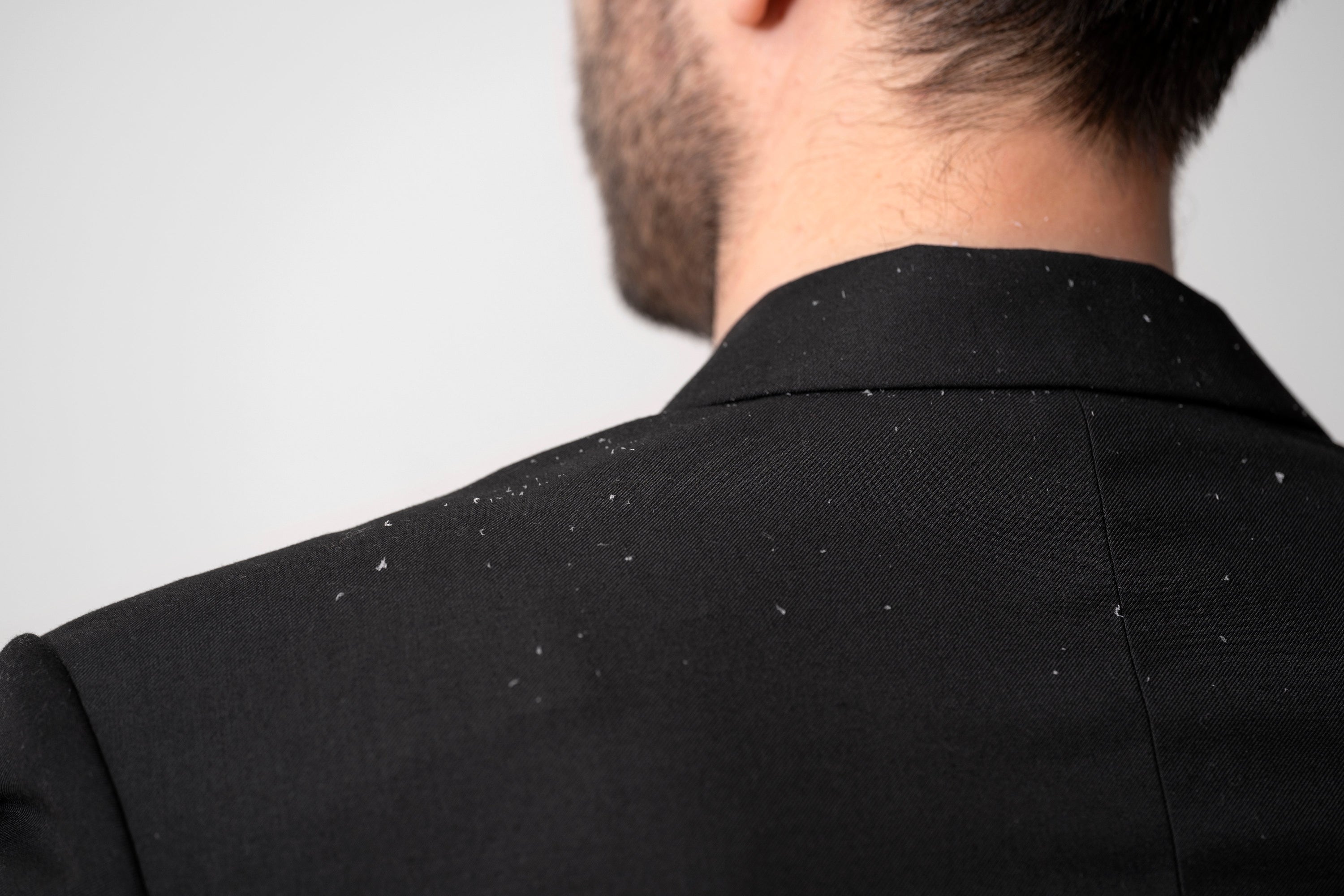 Types of Dandruff