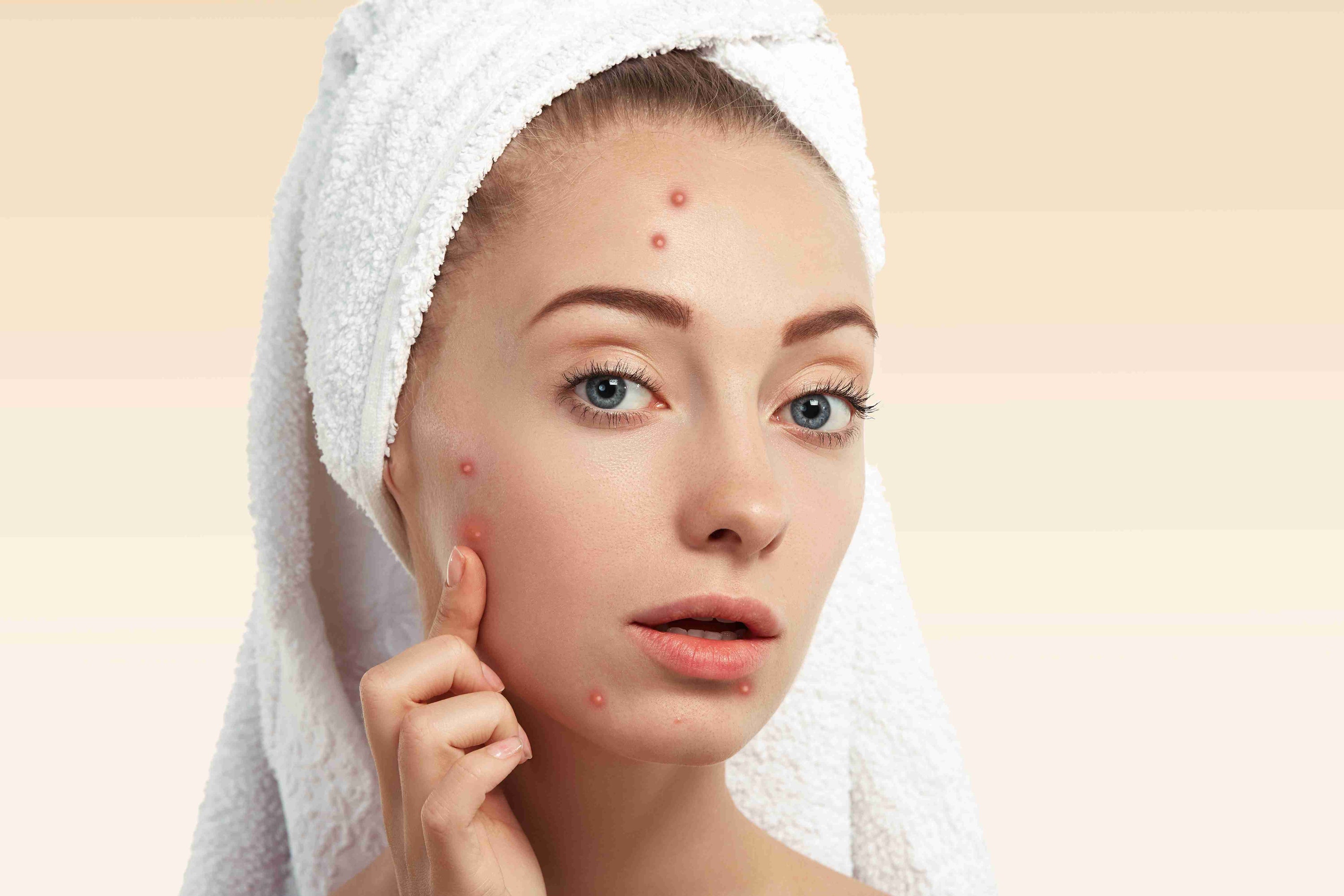 how to reduce acne redness